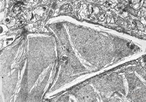 F,15y. | infantile neuroaxonal dystrophy (Seitelberger)